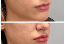 Jawline Contouring West Loop