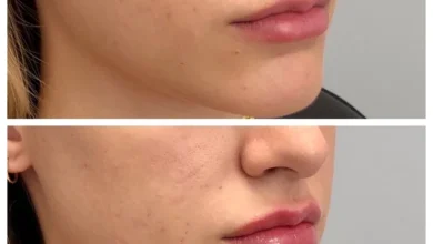 Jawline Contouring West Loop