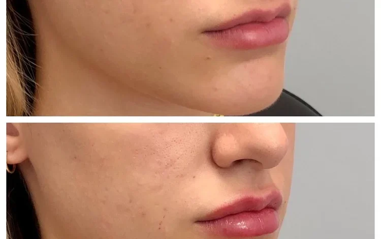 Jawline Contouring West Loop