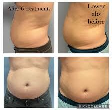 Best Treatment for Fat Loss