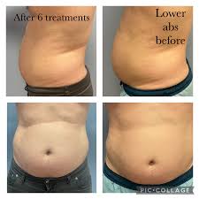 Best Treatment for Fat Loss