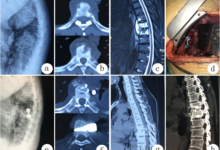 Spine Surgeon in Kerala