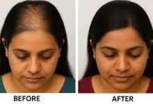 Hair Transplant Cost India