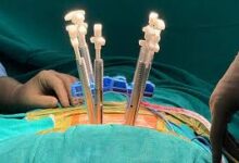 Minimally Invasive Spine Surgery India