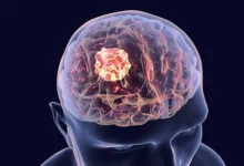 Brain Cancer Treatment in India