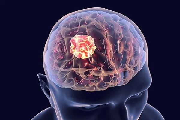 Brain Cancer Treatment in India