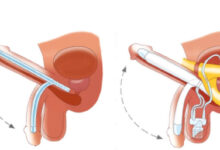 Penile Implant in India