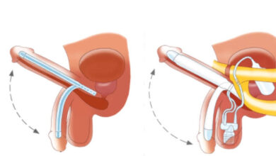 Penile Implant in India