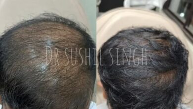 Exosome Treatment in Kolkata