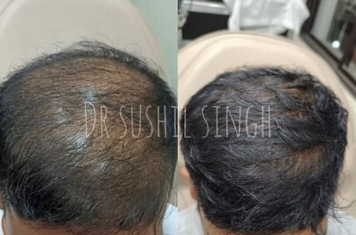 Exosome Treatment in Kolkata